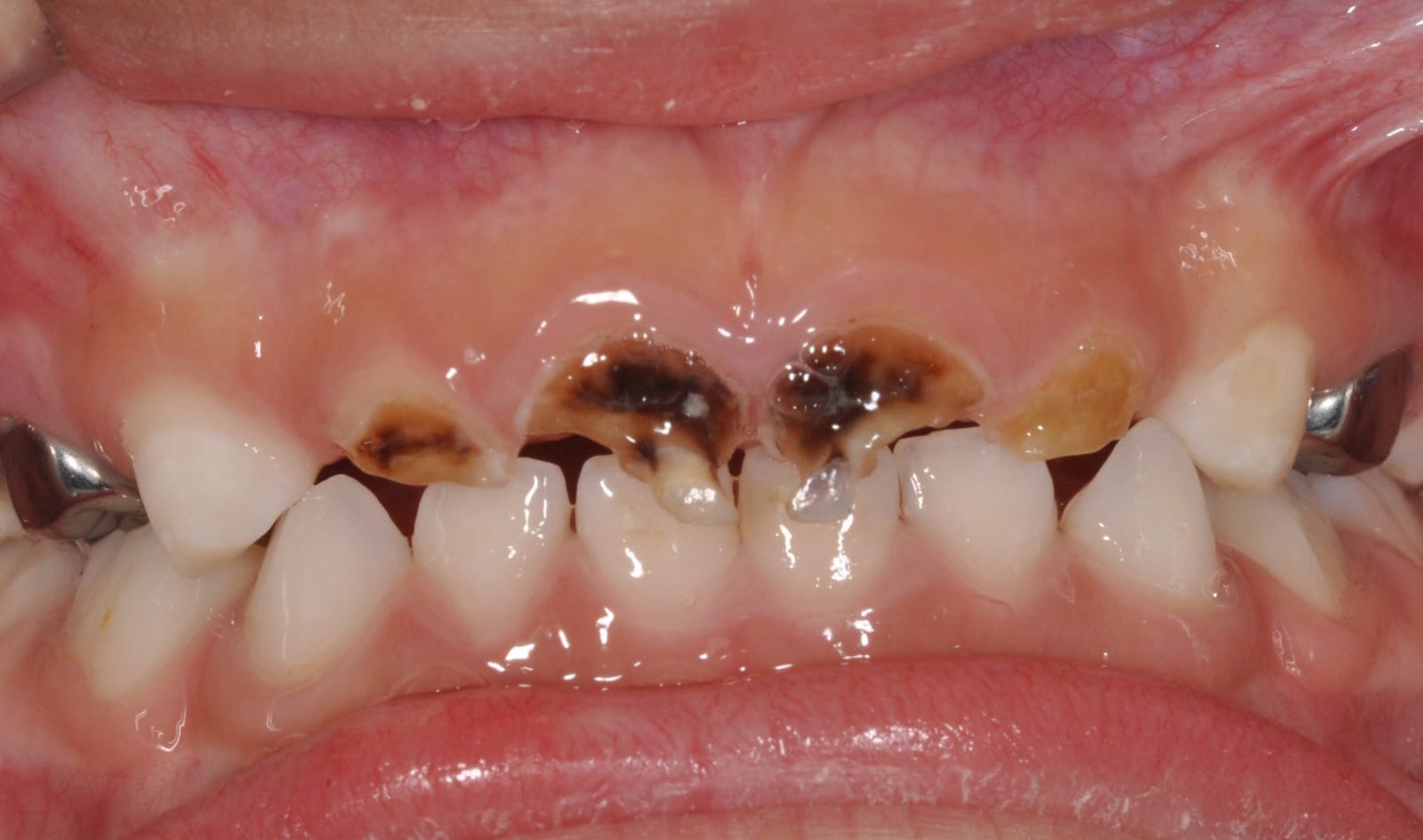 Front baby teeth with dark brown decay along the gumline.