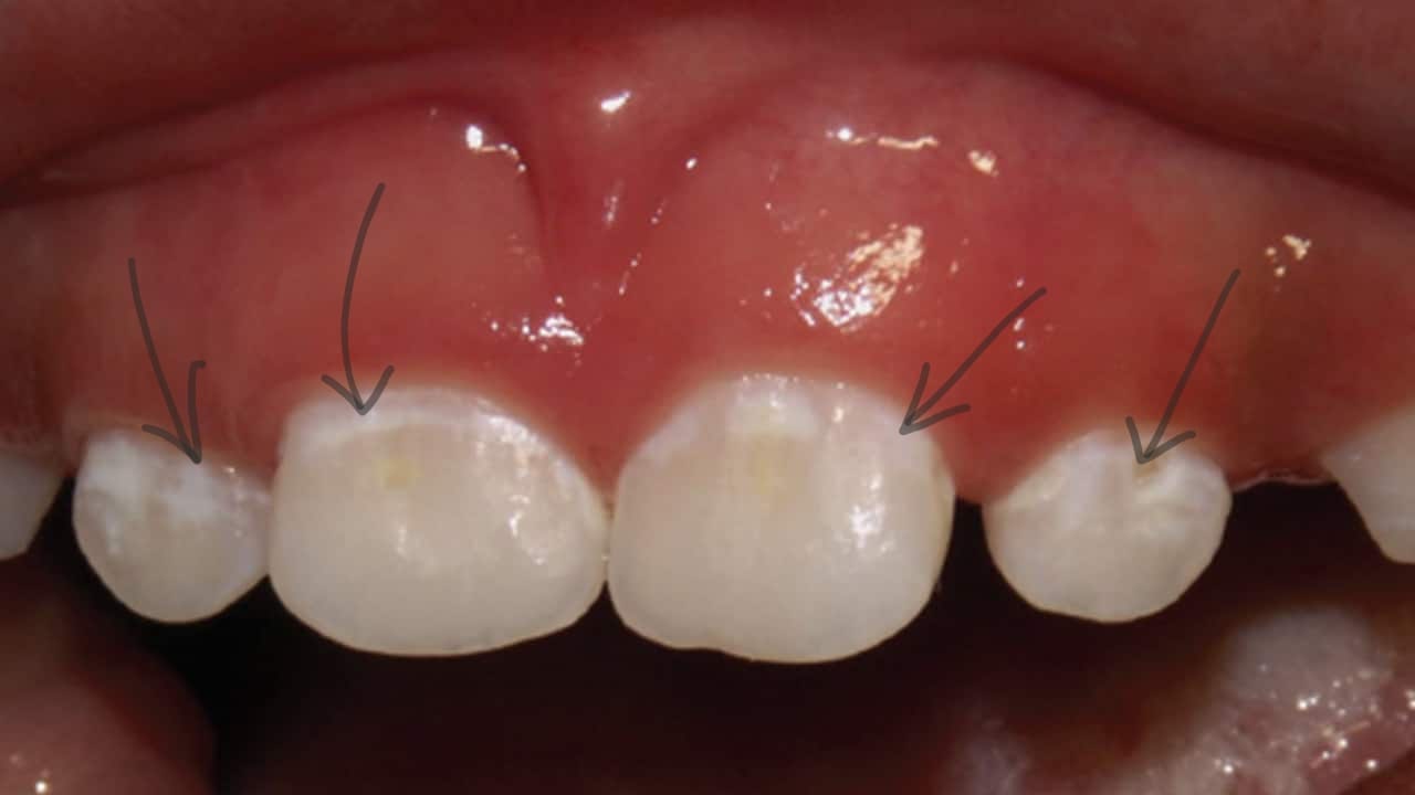 Upper front baby teeth with arrows pointing to chalky white patches along the gumline.
