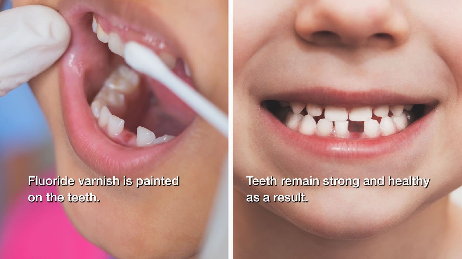 Two photographs side by side. Left: fluoride varnish being painted onto a child’s teeth, captioned “Fluoride varnish is painted on the teeth”. Right: a healthy smile, captioned “Teeth remain strong and healthy as a result”.